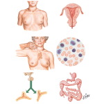 Diffuse Hyperthyroidism (Graves' Disease)