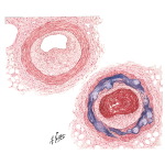 Atherosclerosis in Diabetes