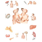 Gynecomastia