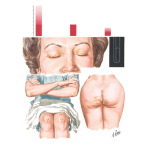 Hypercholesterolemic Xanthomatosis