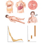 Secondary Hyperaldosteronism