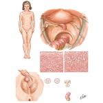 Gonadal Dysgenesis with Medullary Elements