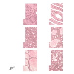 Histology of Thyroid Adenomas