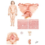 Gonadal Dysgenesis with Cortical Elements