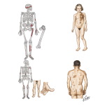 Polyostotic Fibrous Dysplasia (Osteitis Fibrosa Disseminata), Albright's Syndrome; 