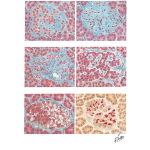 Islet Cell Pathology In Human Diabetes
