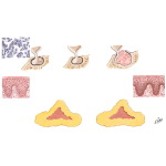 Pathology, Signs, and Symptoms of Cushing's Syndrome