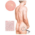 Hypertriglyceridemia