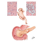 Dysfunction of the Islet Cells