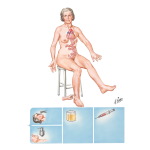 Signs and Symptoms of Toxic Adenoma
