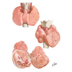 Gross Pathology of Goiter