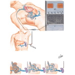 Clinical Determination of Portal Hypertension