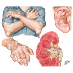 Clinical Aspects of Gout