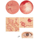 Diabetic Retinopathy and Cataract