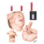 Hypertriglyceridemia