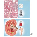 Diabetic Nephropathy and Necrotizing Papillitis