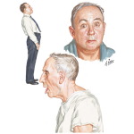 Parkinsonism