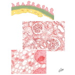 Acute Renal Failure
