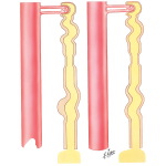 Diuretics - Ethacrynic Acid, Furosemide; Osmotic Diuretics