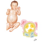 Infantile Nephrosis