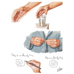 Classification of Parkinsonism