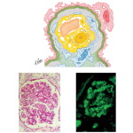 Hemolytic-Uremic Syndrome (Intravascular Coagulation and Thrombotic Microangiopathy)