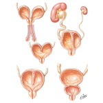 Duplication and Septa of the Bladder