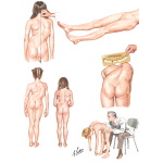 Clinical Evaluation of Scoliosis