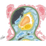 Chronic Glomerulonephritis