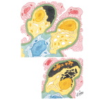 Toxemia of Pregnancy