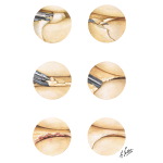 Meniscal Arthroscopic Surgery