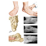 Tarsal Coalition