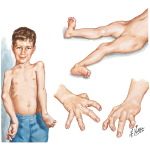 Arthrogryposis Multiplex Congenita