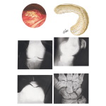 Articular Chondrocalcinosis (Pseudogout)