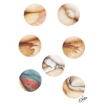 Tears of Meniscus