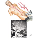 Femorocerebral Angiography