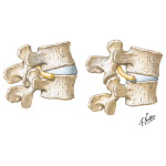 Effects of Lumbar Hyperlordosis and Flexion on Spinal Nerve Roots