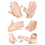 Macrodactyly Toe