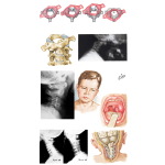 Nonmuscular Causes of Torticollis