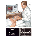 Noninvasive Tests for Carotid Artery Blood Flow