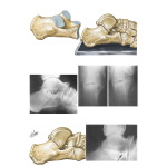 Tarsal Coalition