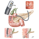 Cannulation of Papilla of Vater and Retrograde Cholangiopancreatopography
