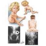 Lumbosacral Agenesis