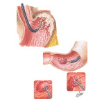 Neoplasms of Stomach