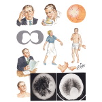 Some Common Manifestations of Brain Tumors