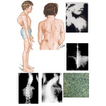 Spinal Deformities in Neurofibromatosis