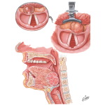 Benign Tumors of Vallecula and Root of Tongue