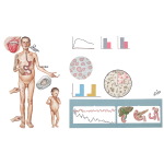 Enterogenous Malabsorption Syndrome (Sprue Syndrome)