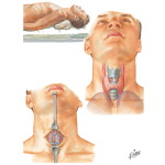Tracheotomy