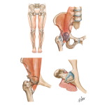 Transient Synovitis; Osteoarthritis